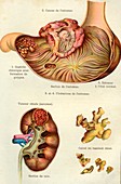 Stomach and kidney diseases, 19th C illustration