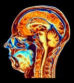 MRI scan of normal brain, artwork