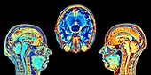 MRI scans of normal brains, artwork