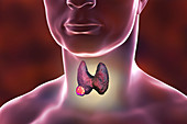 Thyroid gland tumour, artwork