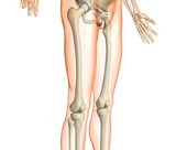Upper leg fracture