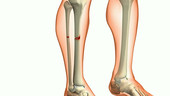 Lower leg fracture