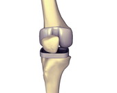 Knee Replacement