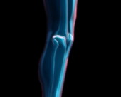 Knee Joint X-Ray 1