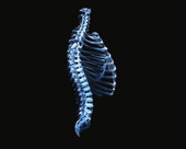 Ribs Spine X-Ray 1