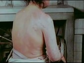 Hiroshima atomic bomb skin burns