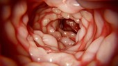 Crohn's disease intestine, animation