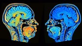 MRI brain scans
