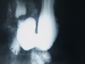 Barium meal, stomach X-ray footage