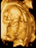 16-week-old twin foetuses, 3D ultrasound scan