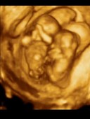 13-week-old twin foetuses, 3D ultrasound scan