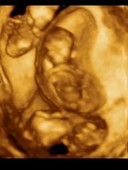12-week-old triplet foetuses, 3D ultrasound scan