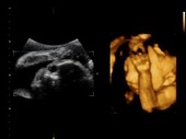 26-week-old foetus, ultrasound scans