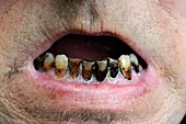 Tooth decay in a smoker