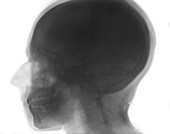 Skull X-ray, 1896