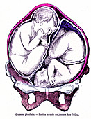 Twins in the womb, 19th Century illustration