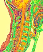 Upper spinal cord and vertebrae, 3D MRI scan