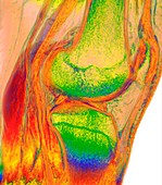 Human knee, 3D MRI scan