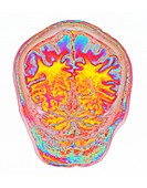 Human head and brain, 3D MRI scan