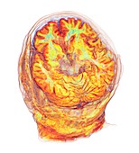 Brain in white matter disease, 3D MRI scan