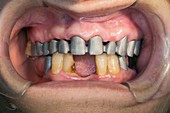 Dental bridge preparation