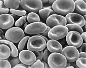 Sickle cell human blood, SEM