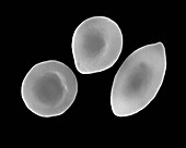 Healthy, intermediate, and sickle red blood cells, SEM