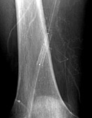 Leg artery angioplasty, X-ray