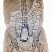 Bottle in rectum, X-ray