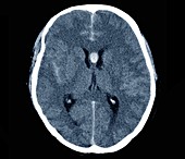 Brain haemorrhage, axial CT scan