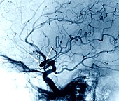 Cerebral aneurysm treatment, angiogram