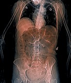 Intestinal gas and swollen abdomen, CT scan