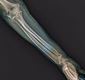 Fractured ulna arm bone, X-ray