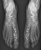 Bunion surgery, feet X-ray