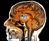 Astrocytoma brain cancer, MRI scan