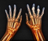 Rheumatoid arthritis of the hands, X-ray