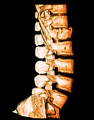 Spinal injury, 3D CT scan