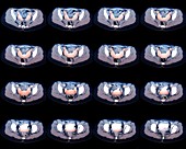 Two-horned uterus, axial pelvic CT scans