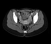 Two-horned uterus, axial pelvic CT scan