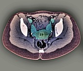 Two-horned uterus, axial pelvic CT scan