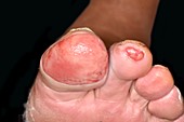 Infected toes in type 1 diabetes