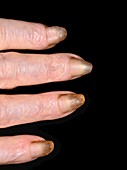 Fingernails in pachyonychia congenita