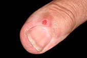 Cyst on the thumb