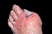 Toe amputation with infection
