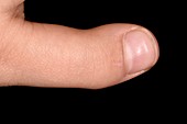 Child's dislocated thumb