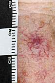 Angioma