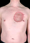 Dermatofibrosarcoma surgery scar