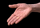 Reoccurring Dupuytren's contracture