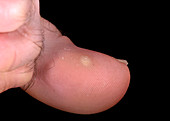 Common warts