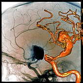 Cerebral aneurysm, 2D and 3D angiograms